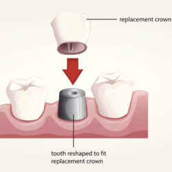 dental crown for tooth